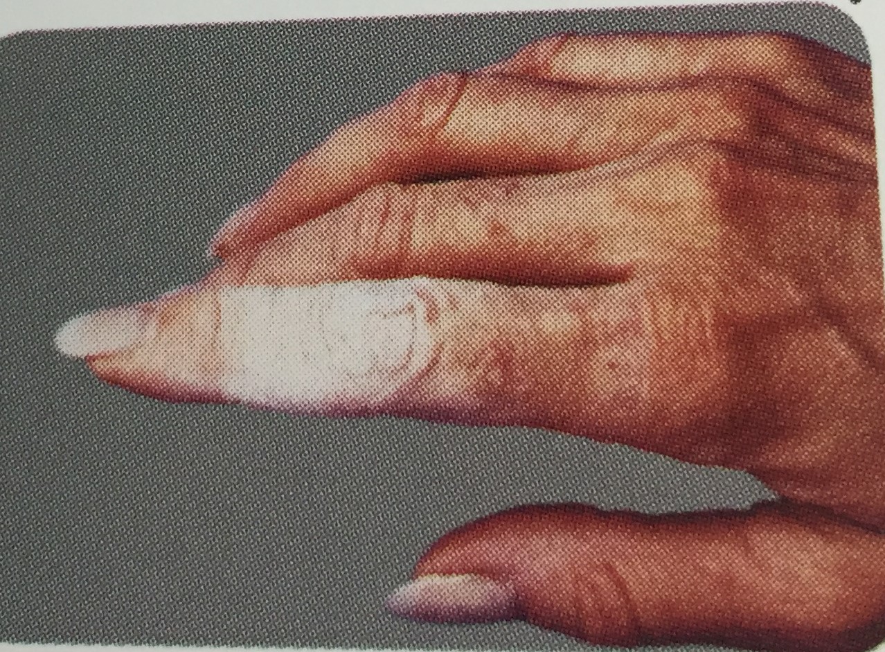 浙大一院marsi医用黏胶相关性皮肤损伤知识调查表复制